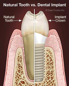Brick NJ Natural Tooth Implants
